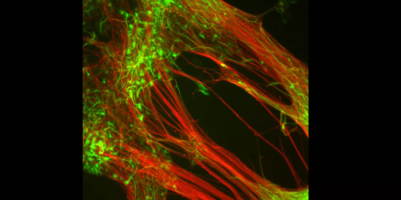 Dopamine-producing neurons that researchers from Lund University have grown in the laboratory from human embryonic stem cells (Photo: Agneta Kirby)