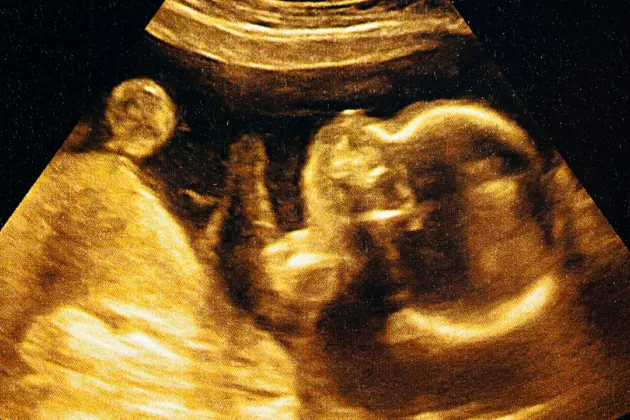 An ultrasound image of a human fetus in the womb.